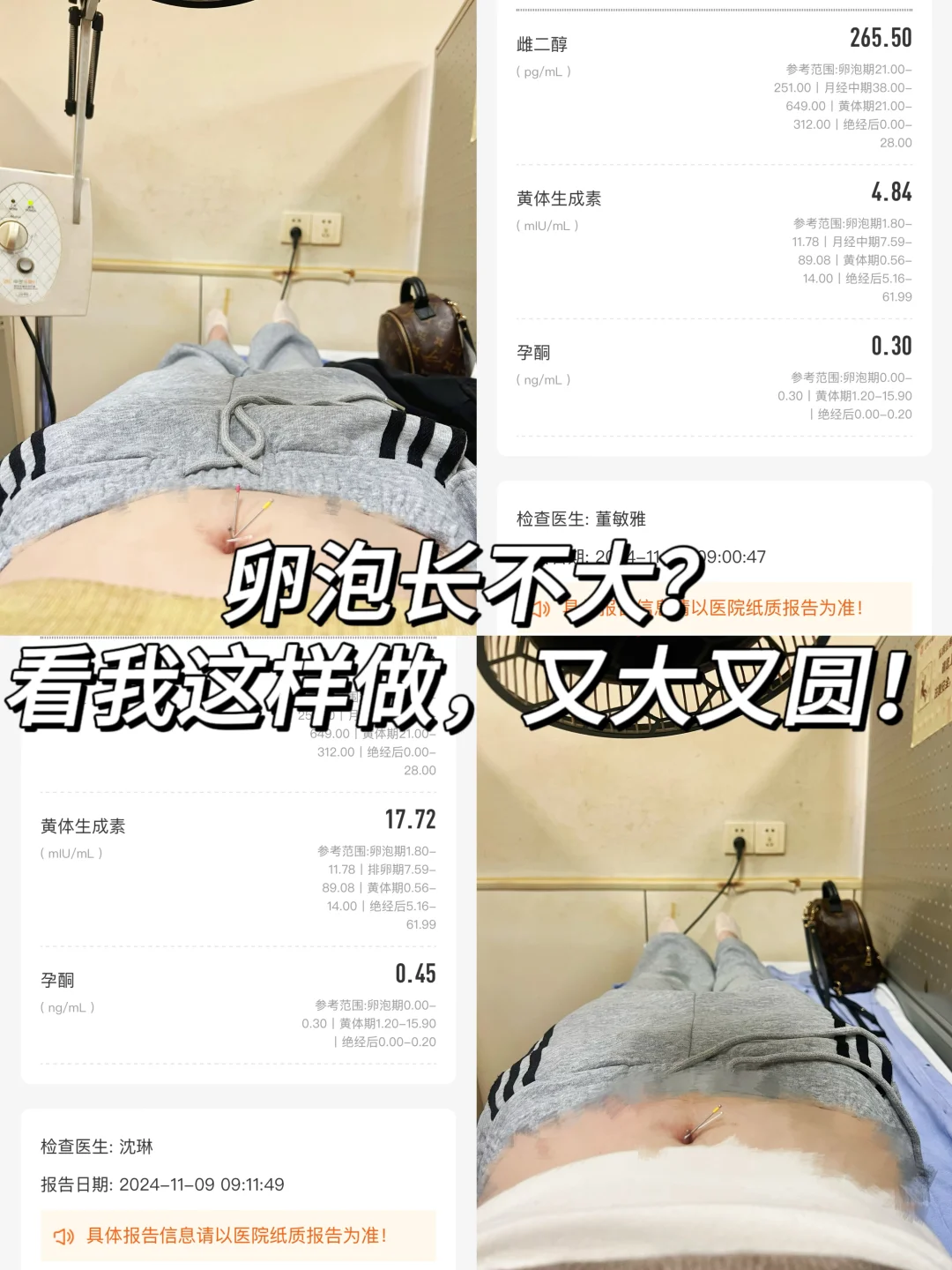 针灸助力备孕，卵泡又大又圆！,现在代孕收费标准