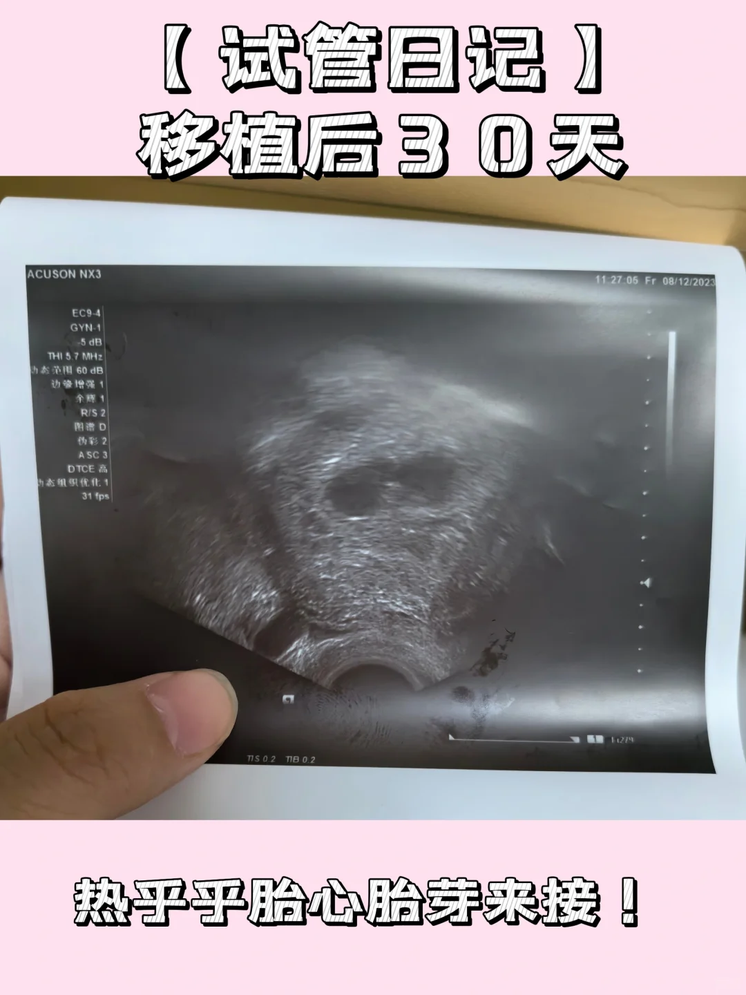 【试管日记】胎心初现，孕育新希望！